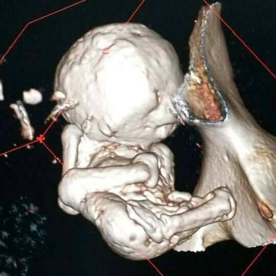 Skikda Une Femme Agee Vit Avec Un Fœtus Calcifie Dans Le Ventre Depuis 30 Ans Trucs Et Tutos
