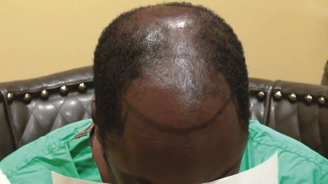 Men Who Go Bald Before Age 40 Risk Heart Attack Study Macosa Legacy
