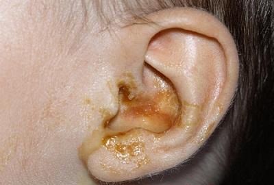 viêm tai giữa chảy mủ