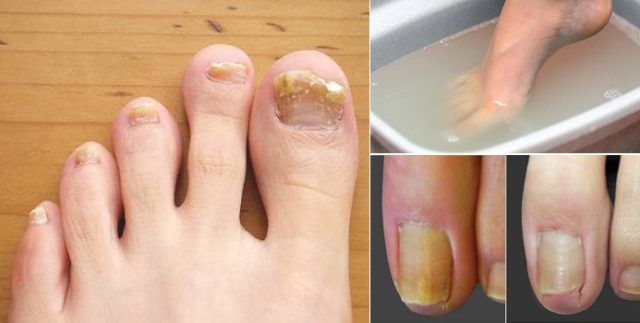 ongle fongique ongle fongique