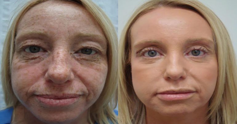 huile pour rides visage huile pour rides visage
