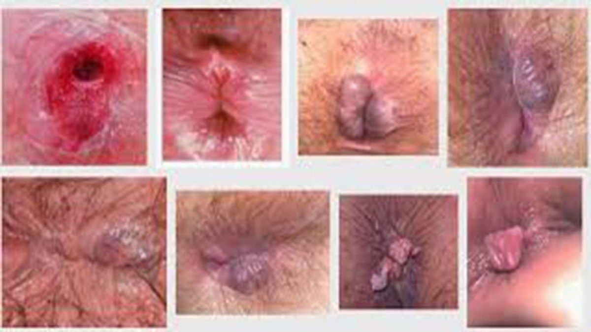 Image Jual Obat Wasir Keluar Benjolan/Bengkak