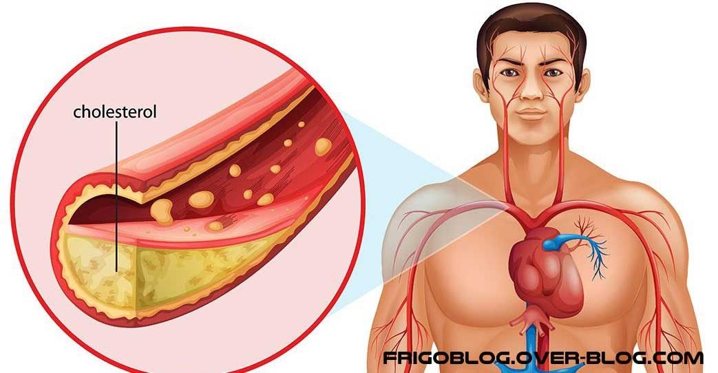 Khasiat QnC Jelly Gamat Untuk Menurunkan Kolesterol Tinggi