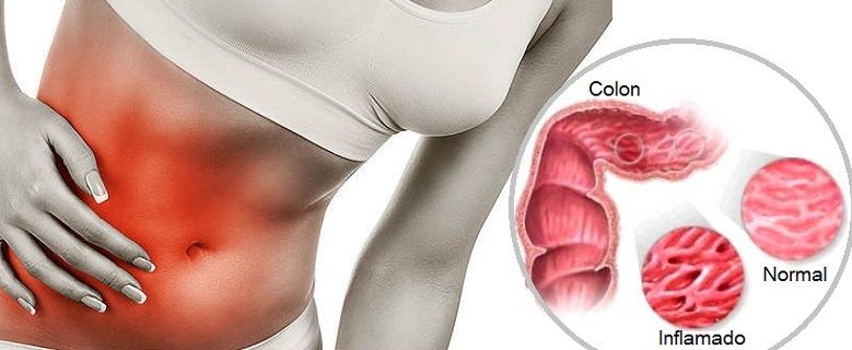 Sintomas colon irritable en hombres