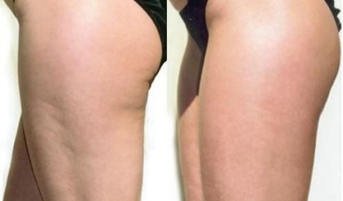 eliminare la cellulite in una settimana