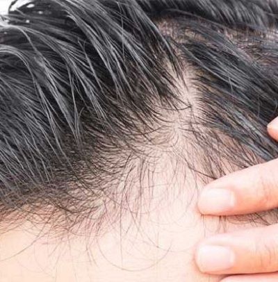 mesotherapie cheveux efficace