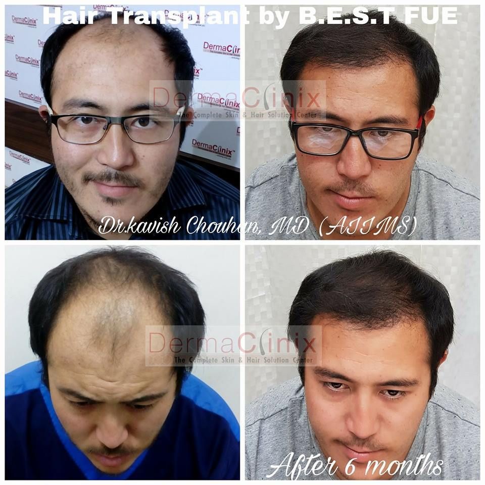 Why Not All Women Are Good Candidates For Hair Transplant