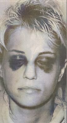 karla-homolka-blessures-violeur-de-scarborough-2-psycho-criminologie.com