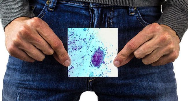 atasi penyakit kelamin dengan obat ini
