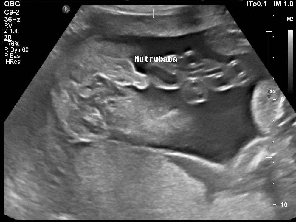 Echo T2 24 Sa Ou 22 Sg En Attendant Bebe Echo T2 24 Sa Ou 22 Sg En Attendant Bebe