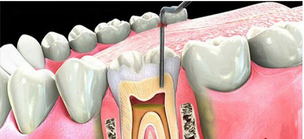 bệnh viêm lợi chân răng nguyên nhân
