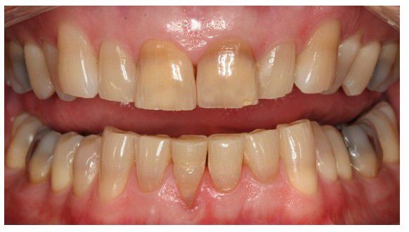 răng vàng có tẩy trắng được không 2018