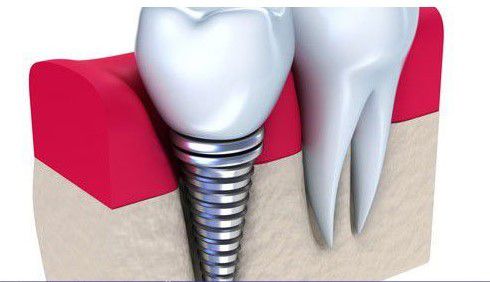 trồng răng implant có nguy hiểm không