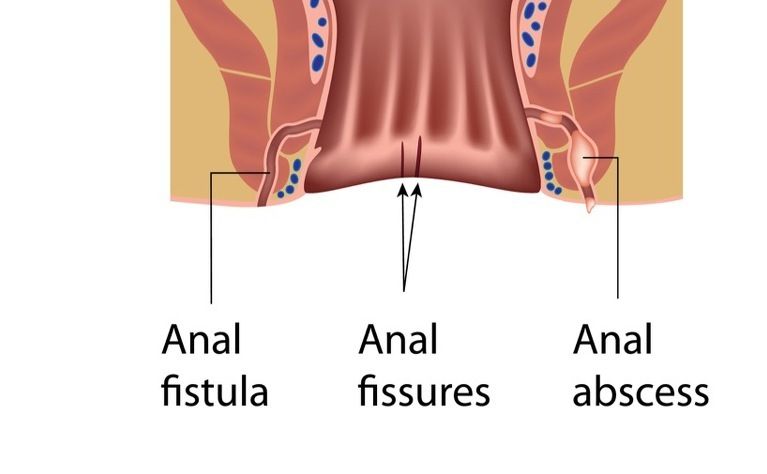 Tips Menyembuhkan Penyakit Abses Anus