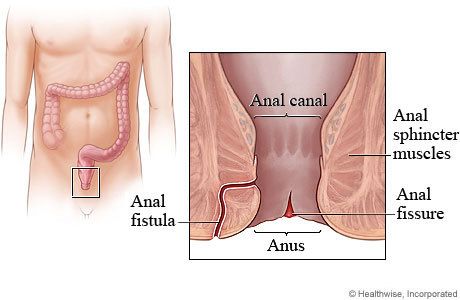 Tips Menyembuhkan Penyakit Abses Anus
