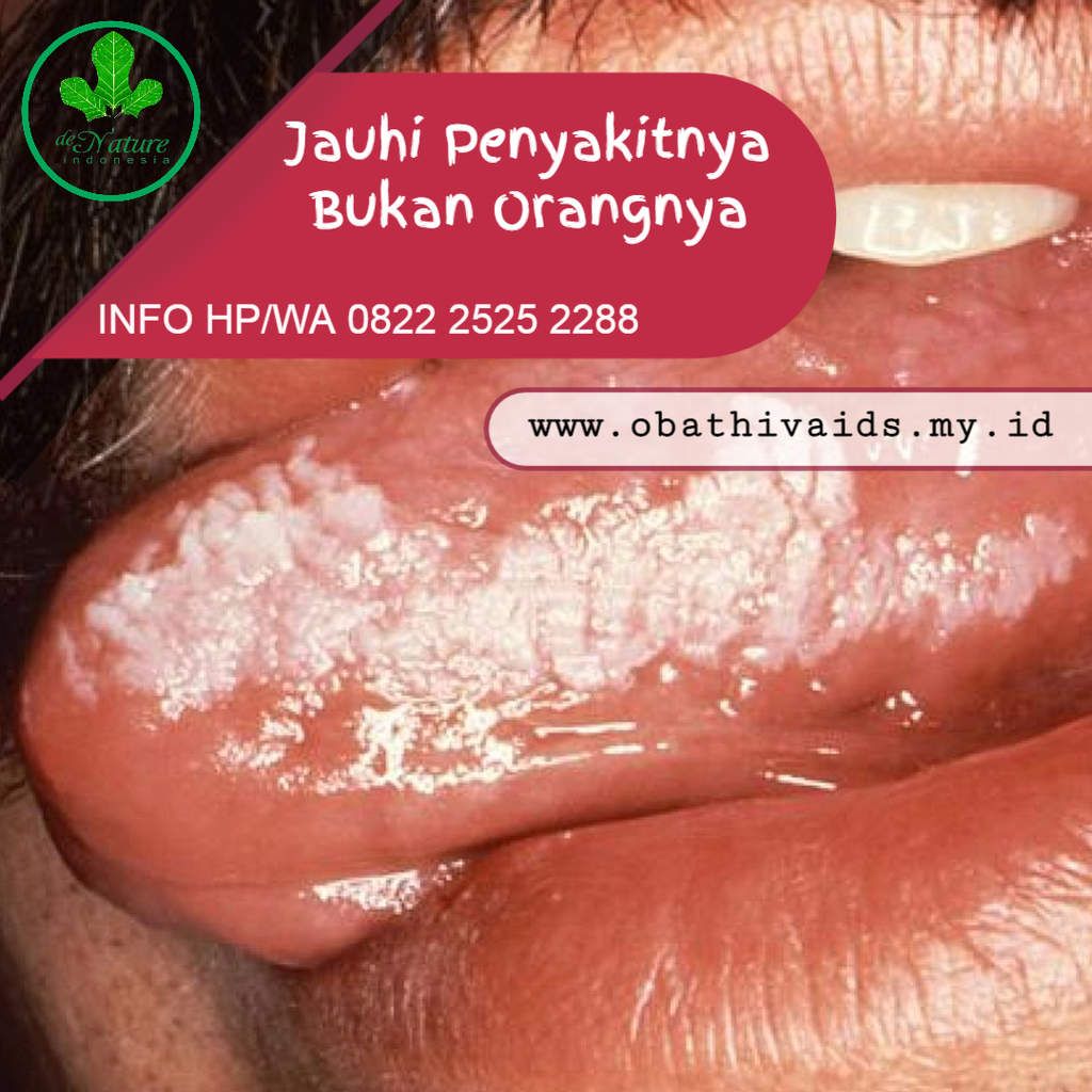Gejala Awal HIV