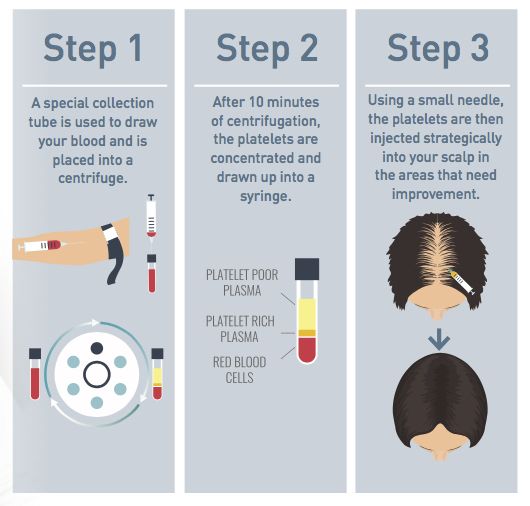 Platelet Rich Plasma Therapy Hair Nishapatel696969 Over Blog Com