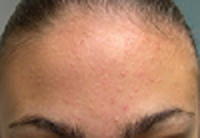 urcil_cheveux_boutons_acné