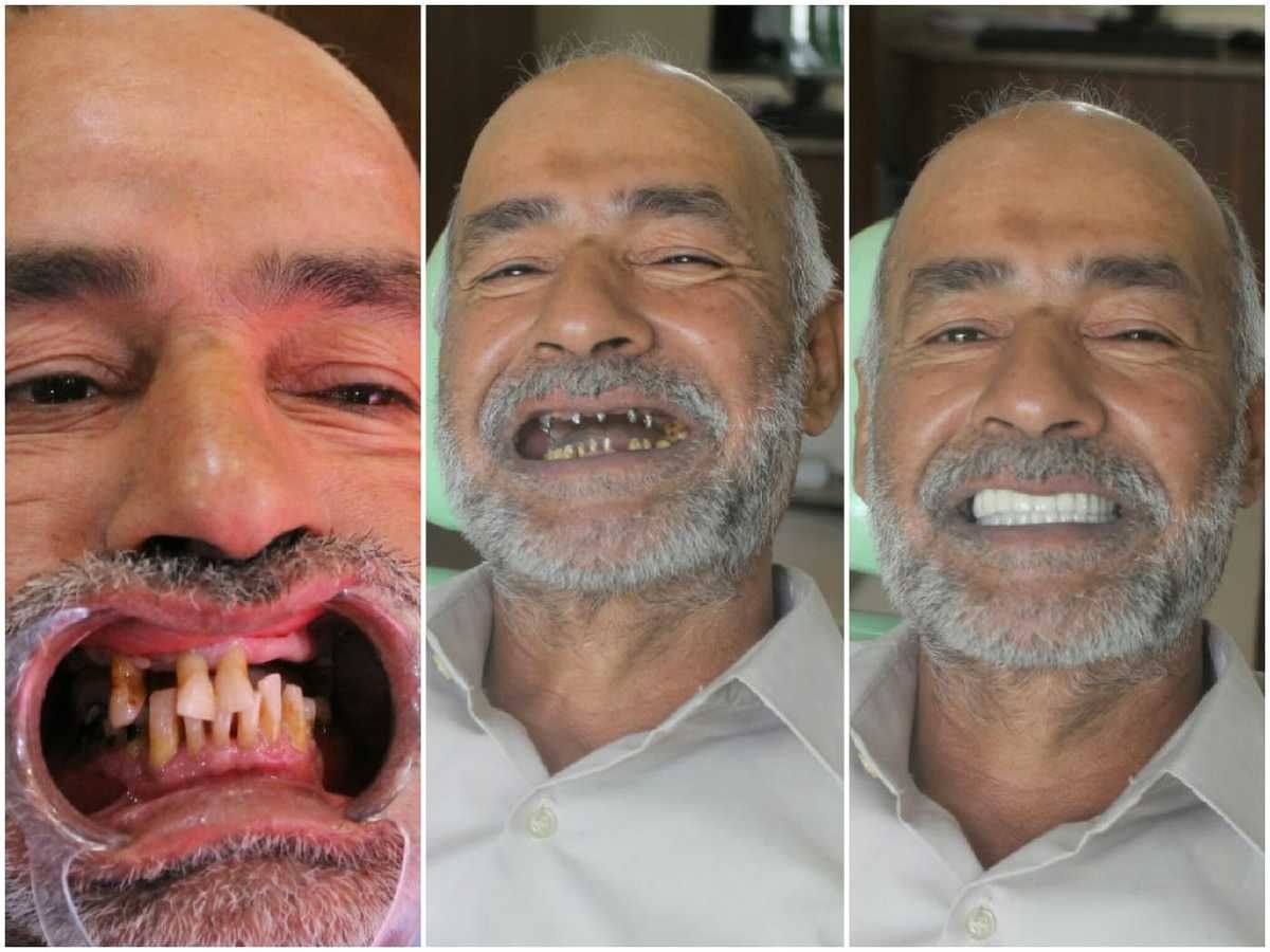 تكلفة الزراعة الفورية للاسنان في الهند