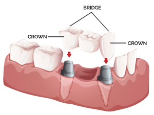 full cast metal crowns and bridges pros and cons american cast crowns