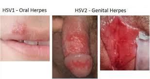 herpes genital 1.jpg