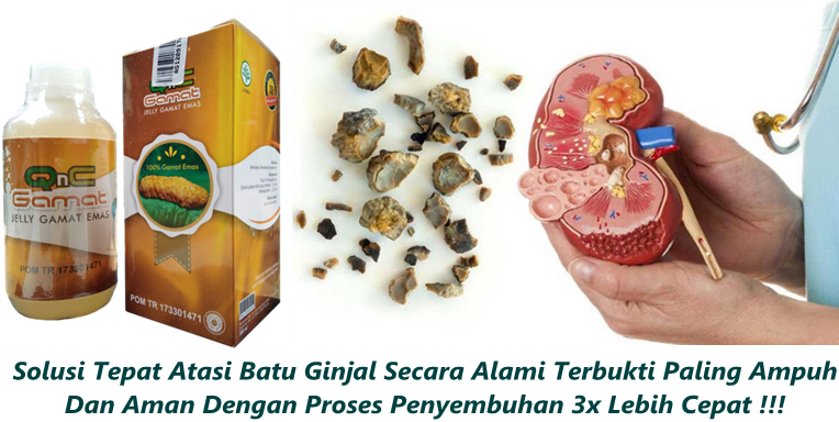 Cara Mengobati Batu Ginjal Secara Alami