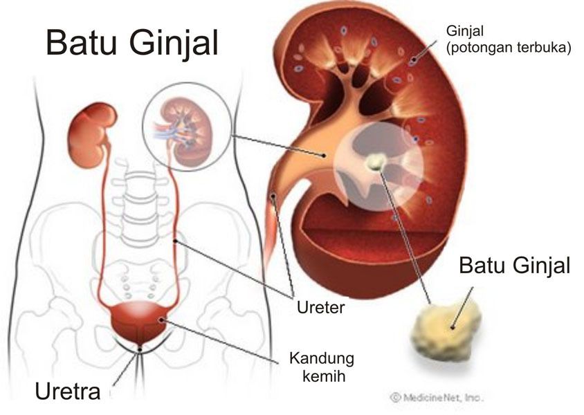 Cara Mengobati Batu Ginjal Secara Alami