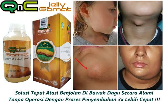 Cara Menghilangkan Benjolan Di Bawah Dagu