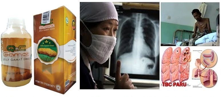Pengobatan TB Paru Secara Alami Terbukti Ampuh