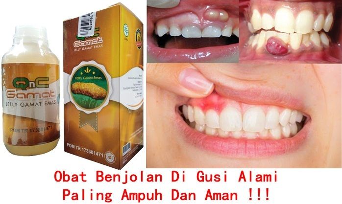 Cara Mengobati Benjolan Di Gusi Secara Alami