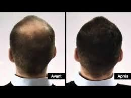 Huile d olive pousse des cheveux Huile d olive pousse des cheveux