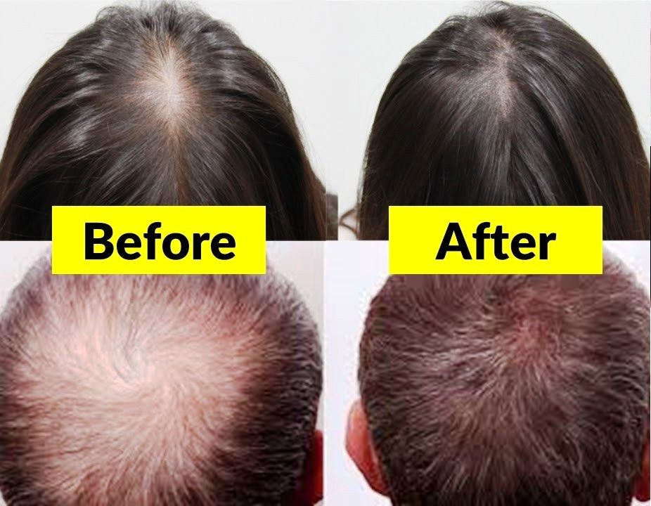 Best Hair Growth Treatment Priceinfo Over Blog Com